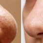 Whiteheads vs Blackheads: What's the difference? 5 home remedies to treat them