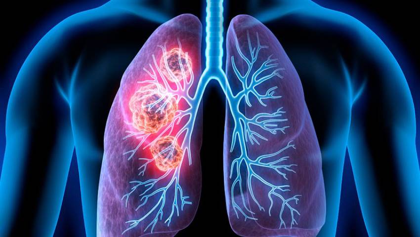 Early lung cancer warning signs that you shouldn't ignore