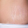 Home Remedies to Naturally Reduce Stretch Marks