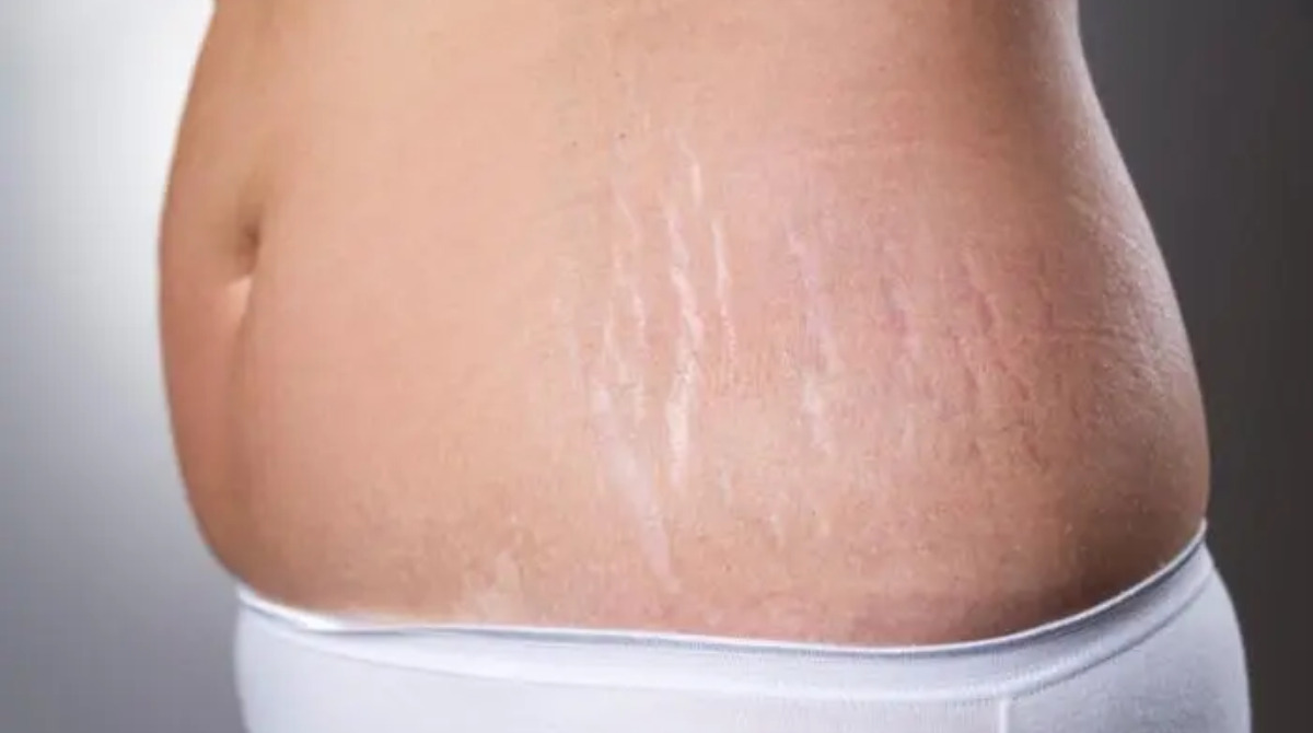 Home Remedies to Naturally Reduce Stretch Marks
