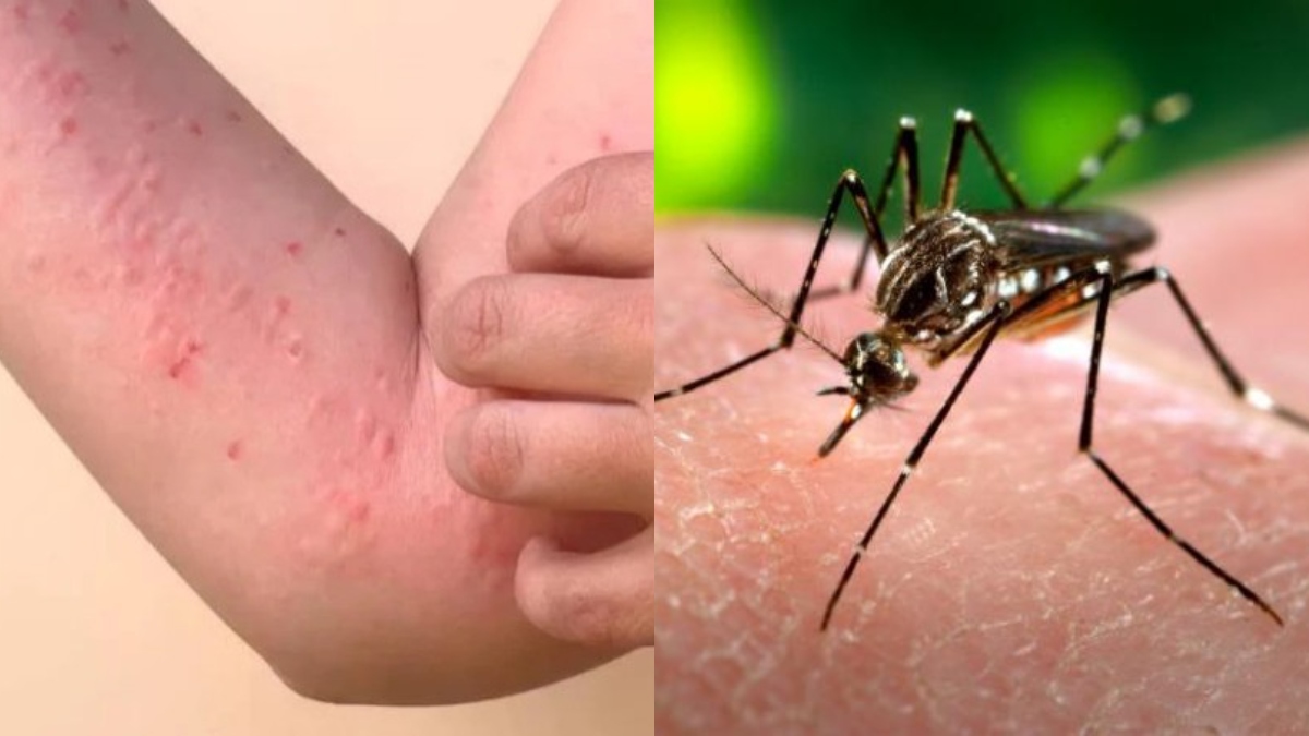 Prevention of Chikungunya Virus Disease