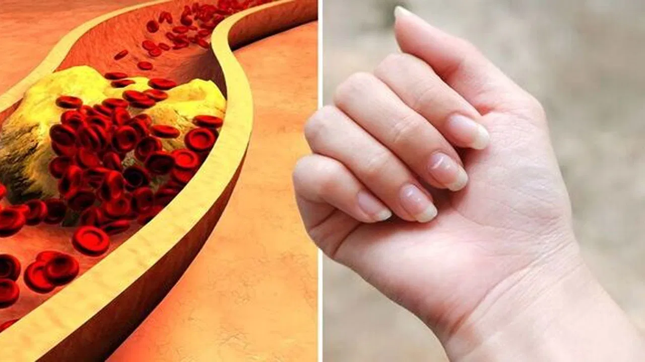 Could it be high cholesterol? Signs on hands and legs to pay attention to