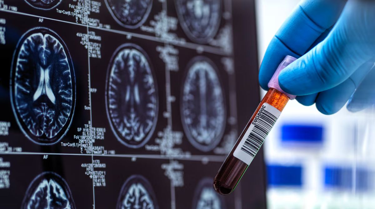 Alzheimer's Blood Test Detects Early Stages of Disease