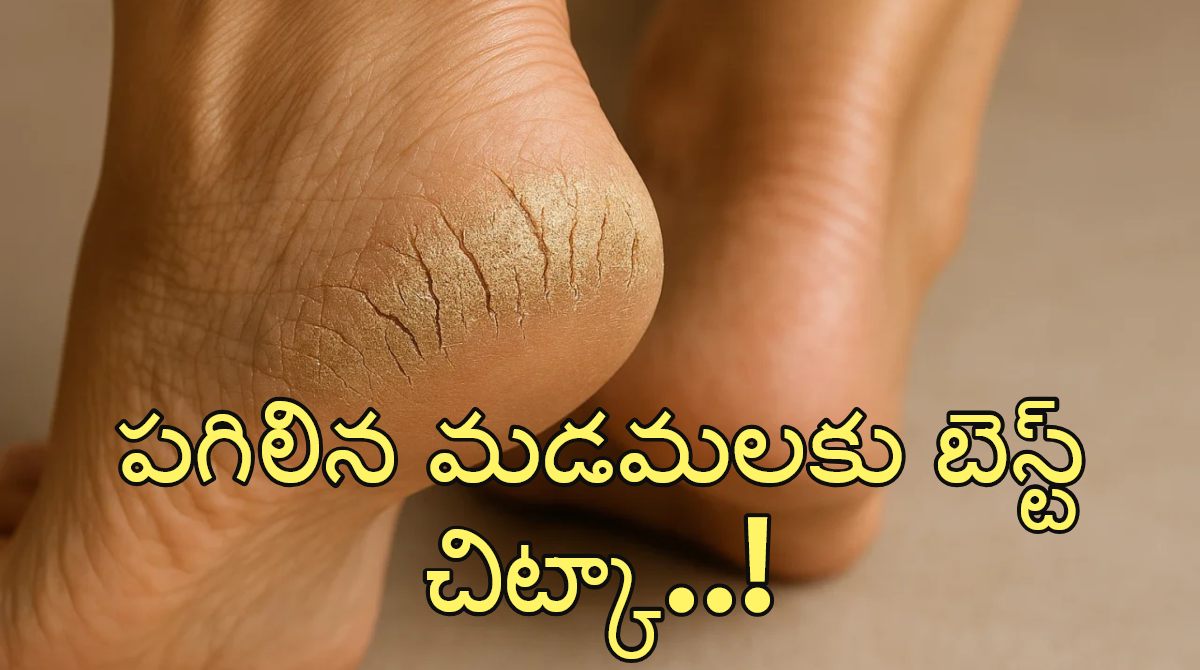 Foot Care Tips: Prevent and Treat Cracked Heels