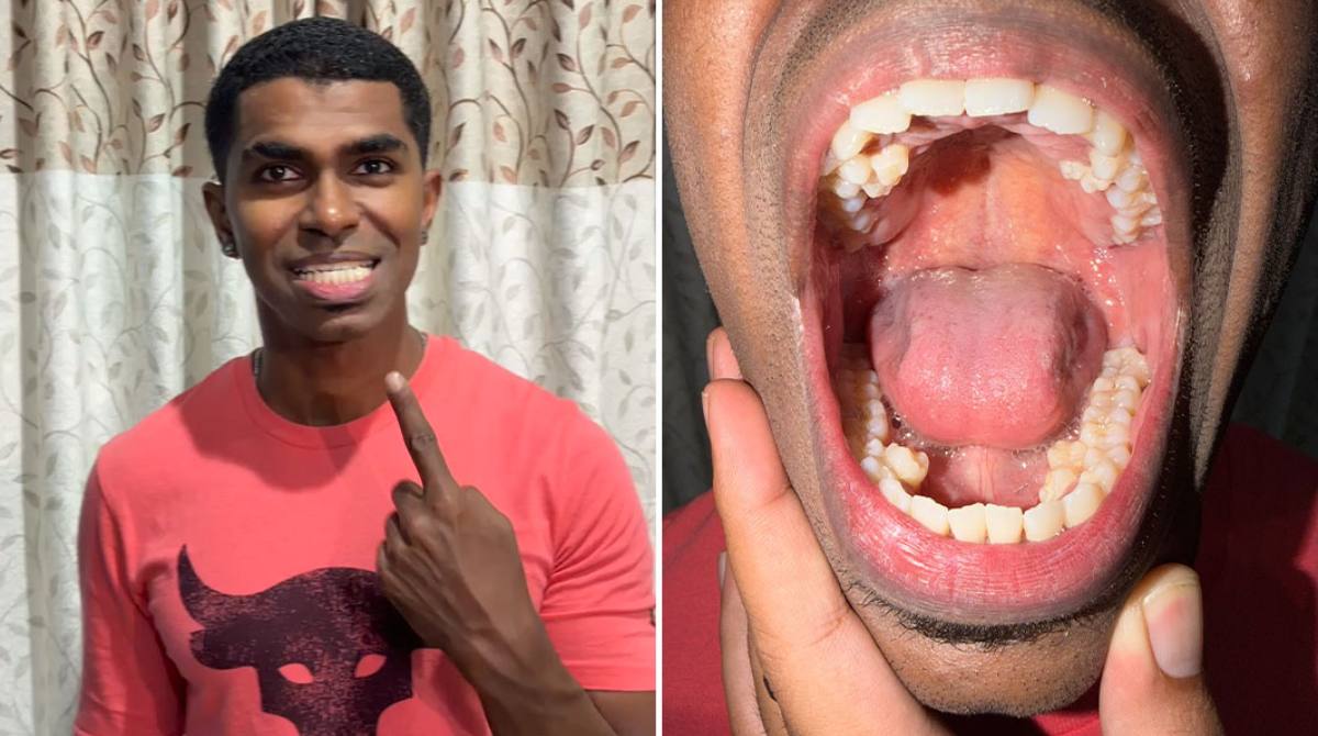 Man with the most teeth in the world flashes his record-breaking smile