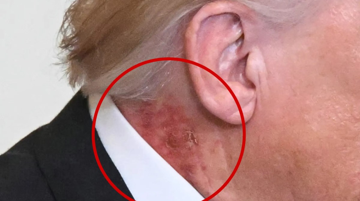 Trump Appears With Red Rash On Neck, Officials Say Caused By Skin Cream