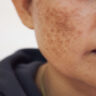 Dark Spots On Skin Causes, Prevention And Remedies