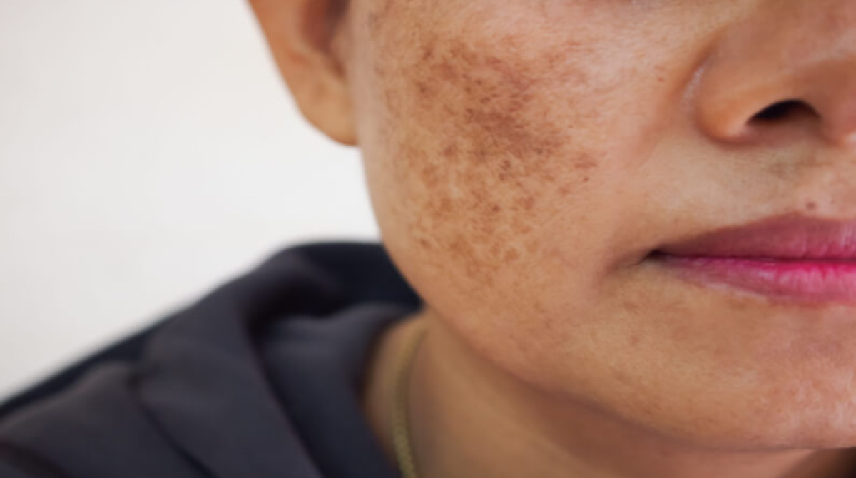 Dark Spots On Skin Causes, Prevention And Remedies