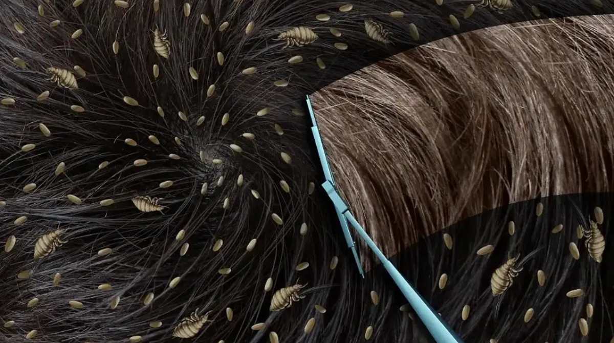 Effective Home Remedies for Lice Removal