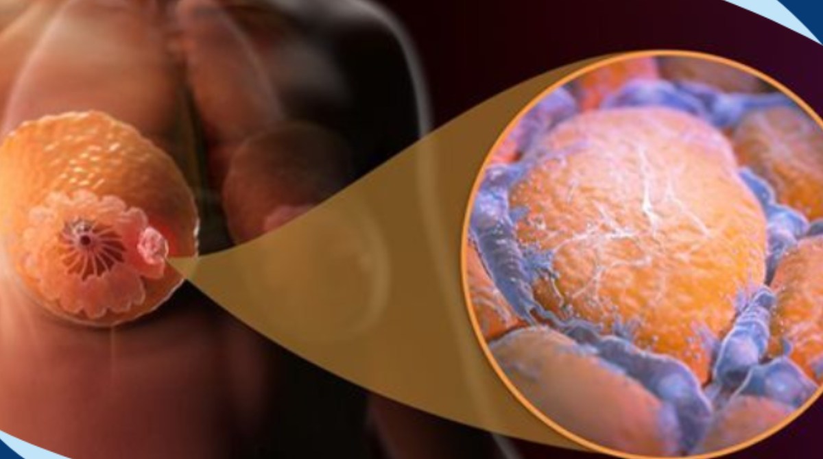 Male Breast Cancer: Symptoms, Causes & Treatment