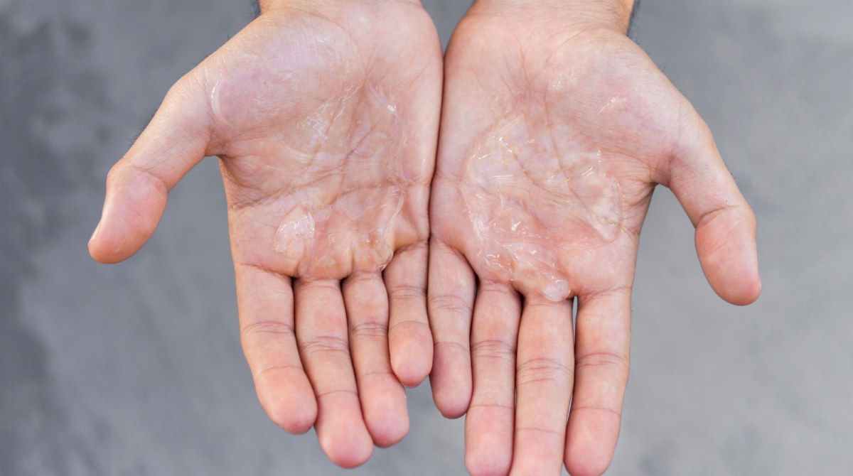Peeling hands: Causes, treatments, and more