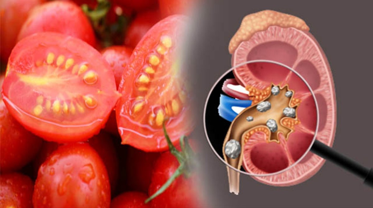 Tomatoes Cause Kidney Stones: Myth Or Fact?