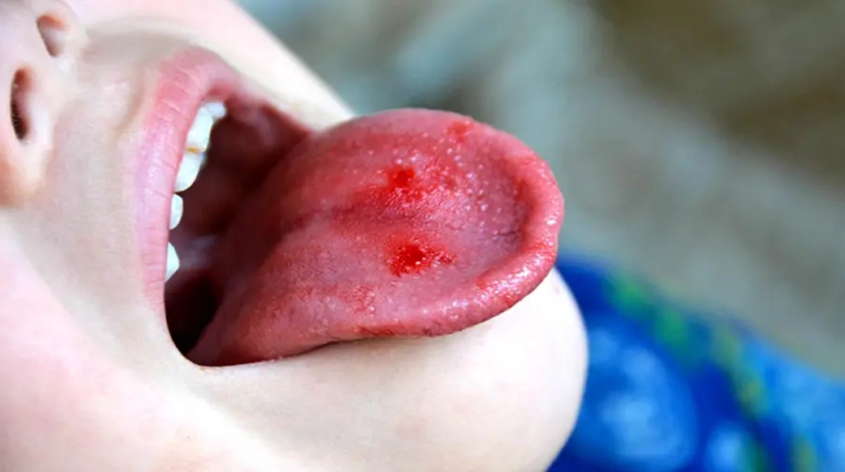 Tongue Cancer Symptoms: Early Signs You Shouldn't Ignore