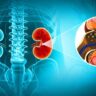 Kidney stones: symptoms & prevention tips