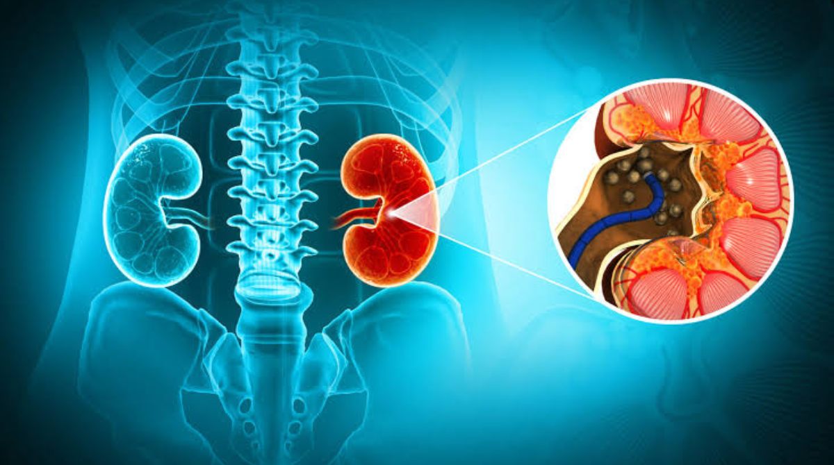 Kidney stones: symptoms & prevention tips